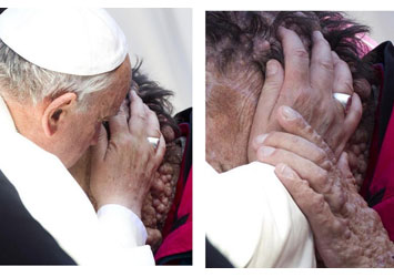 Pope Francis Blessing a Disfigured man 